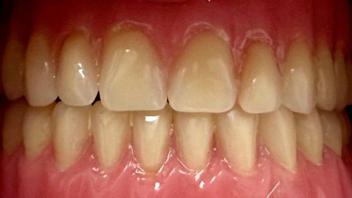 Tratamiento-Prótesis-fija-Después-Personal-Dent