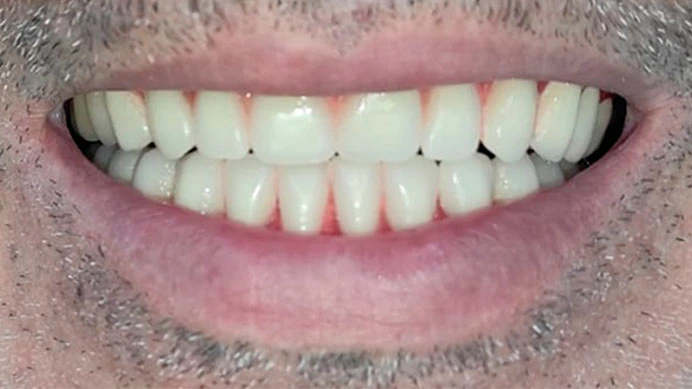 Tratamiento-Sobre-Dentadura-Después-Personal-Dent